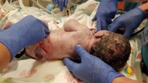 spina bifida at birth