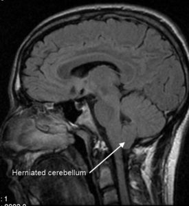 MRI chiari